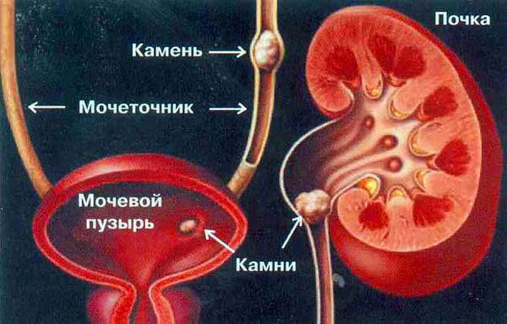 Bubrežni kamen: liječenje s narodnim lijekovima