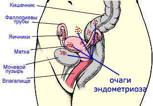 Endometrioza: liječenje narodnim lijekovima
