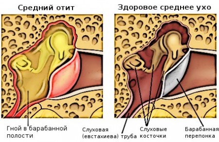 Kako liječiti otitis u kući?