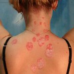 Kako liječiti psorijazu? Kako liječiti psorijazu?