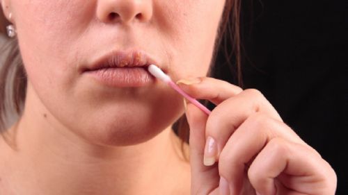 Učinkoviti načini liječenja prehlade na usnama