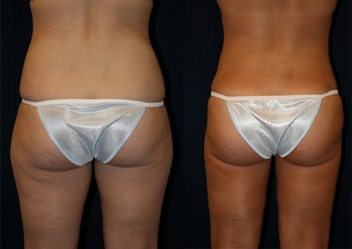 Liposukcija trbuha i bedara: recenzije, fotografije prije i poslije